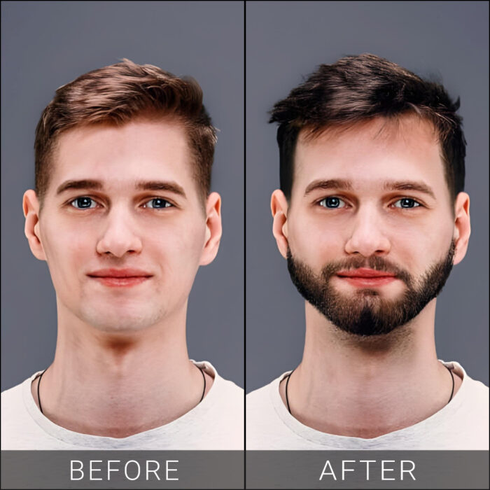 Beard-Transplant