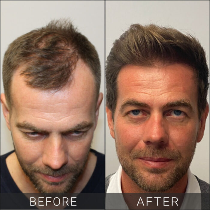 Hair-Transplant