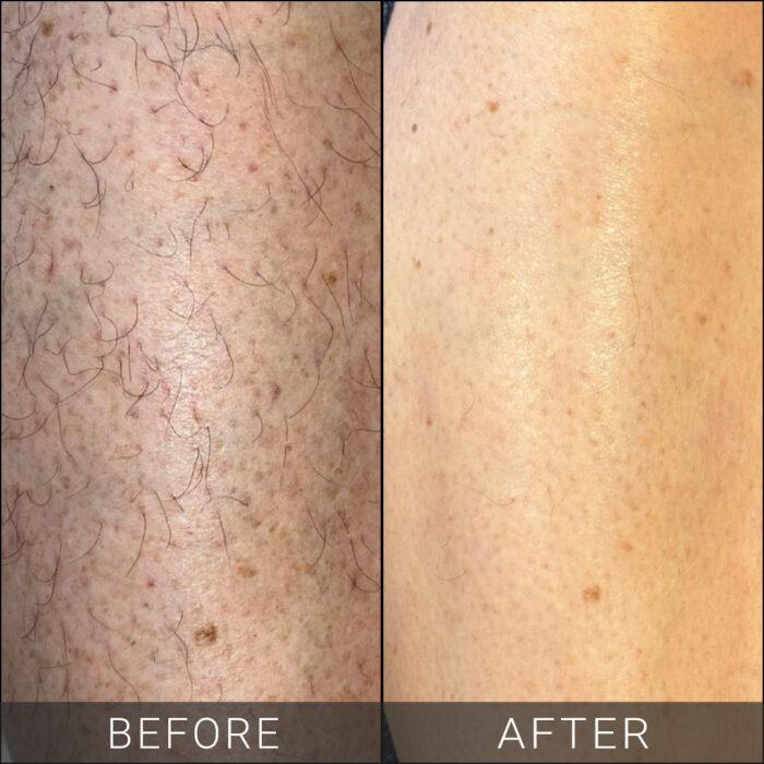 Laser-Hair-Removal