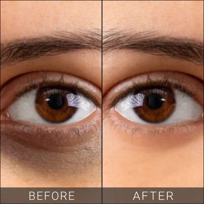 Under-Eye-Dark-Circle
